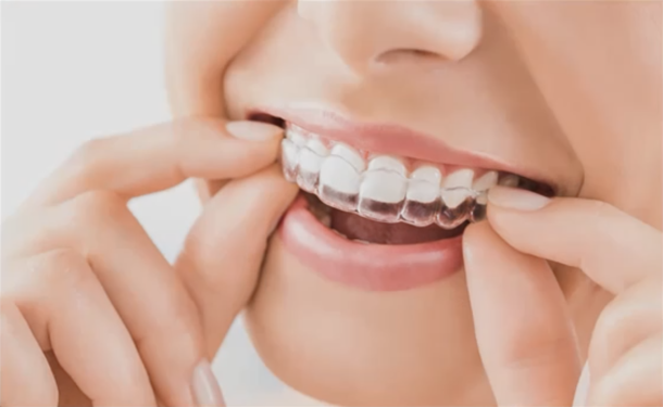 sorriso con bite invisibile